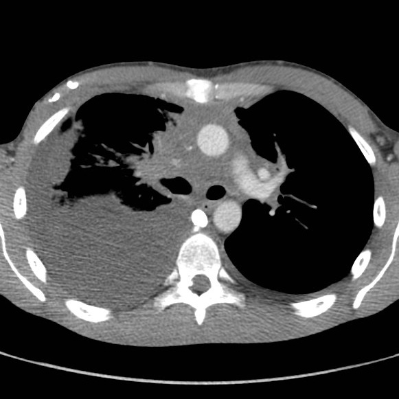 File:Non-Hodgkin lymphoma involving lung (Radiopaedia 29094-29470 B 29).jpg