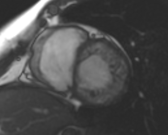 File:Non-compaction of the left ventricle (Radiopaedia 69436-79314 Short axis cine 160).jpg