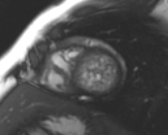 File:Non-compaction of the left ventricle (Radiopaedia 69436-79314 Short axis cine 71).jpg