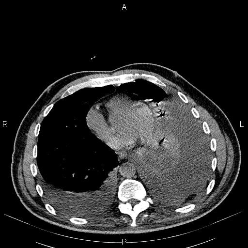 File:Non Hodgkin lymphoma in a patient with ankylosing spondylitis (Radiopaedia 84323-99621 Axial non-contrast 20).jpg