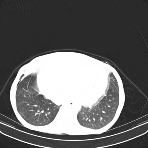 File:Non hodgkin lymphoma of the mediastinum (Radiopaedia 20814-20729 Axial lung window 42).jpg
