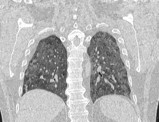 Non specific interstitial pneumonia (NSIP) (Radiopaedia 89725-106798 Coronal lung window 56).jpg