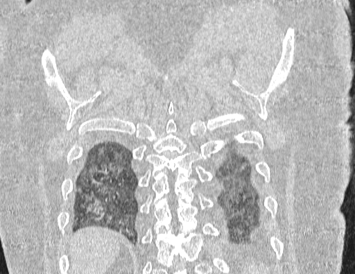 Non specific interstitial pneumonia (NSIP) (Radiopaedia 89725-106798 Coronal lung window 66).jpg