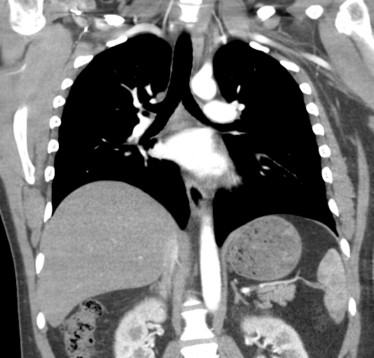 File:Normal CTA thorax (non ECG gated) (Radiopaedia 41750-44704 B 51).png