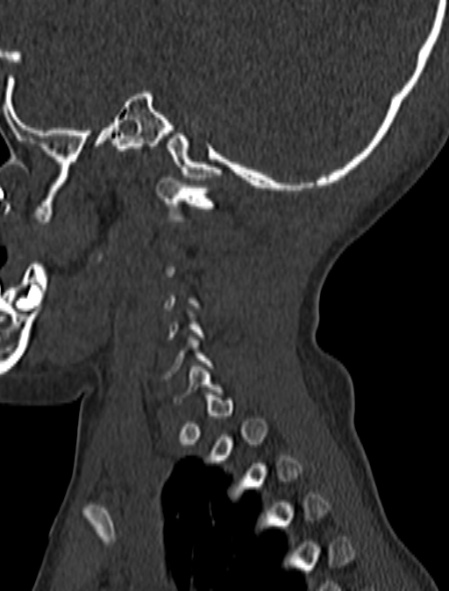 File:Normal CT cervical spine - pediatric (Radiopaedia 52549-58462 Sagittal bone window 21).jpg