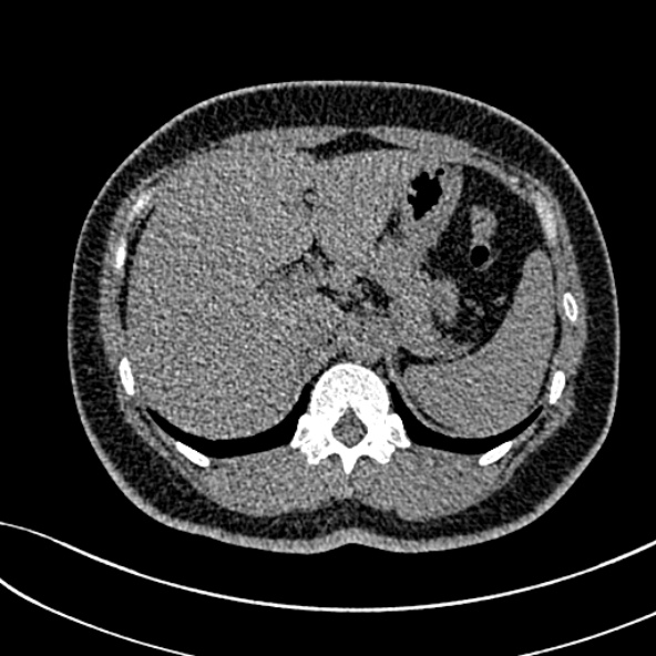 Normal CT chest- adult female (Radiopaedia 52522-58428 Axial non-contrast 127).jpg