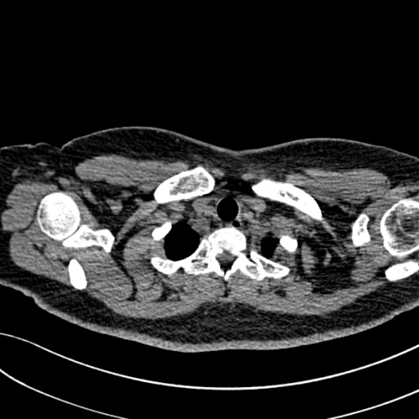 Normal CT chest- adult female (Radiopaedia 52522-58428 Axial non-contrast 14).jpg