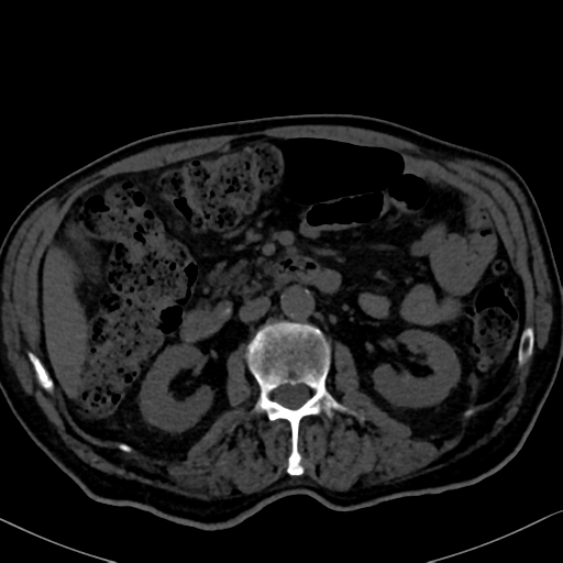 File:Normal CT intravenous cholangiogram (Radiopaedia 38199-40208 Axial IVC 51).png