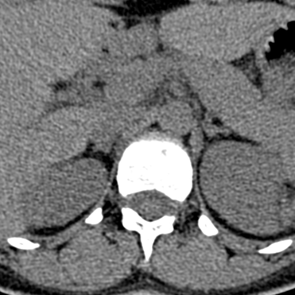 Normal CT lumbar spine (Radiopaedia 53981-60118 Axial non-contrast 7).jpg