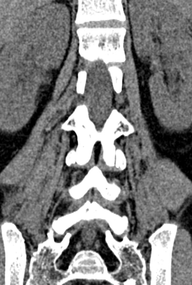 Normal CT lumbar spine (Radiopaedia 53981-60118 F 59).jpg