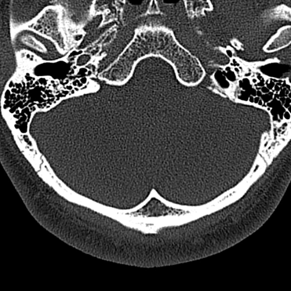 Normal CT of the cervical spine (Radiopaedia 53322-59305 Axial bone window 17).jpg