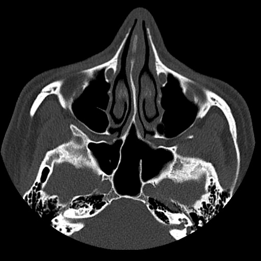 Normal CT paranasal sinuses (Radiopaedia 42286-45390 Axial bone window 64).jpg