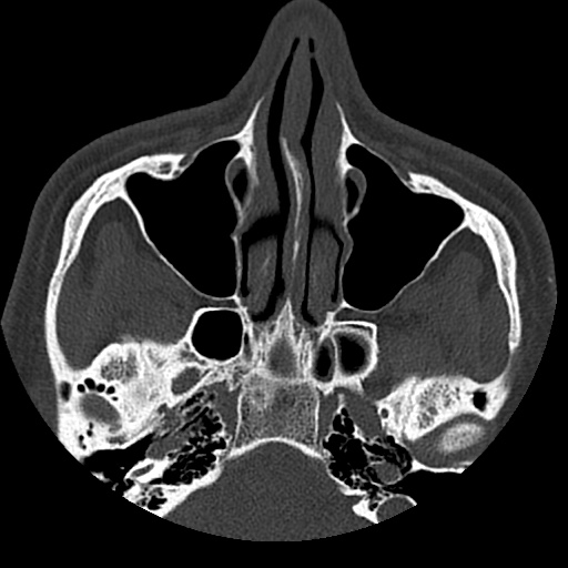 Normal CT paranasal sinuses (Radiopaedia 42286-45390 Axial bone window 71).jpg