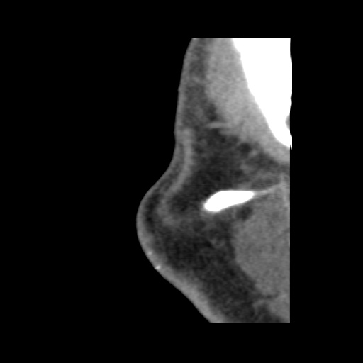 Normal CT paranasal sinuses (Radiopaedia 42286-45390 F 14).jpg