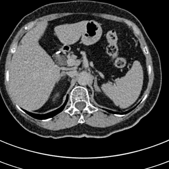 File:Normal CT split bolus study of the renal tract (Radiopaedia 48631-53634 Axial split bolus 19).jpg
