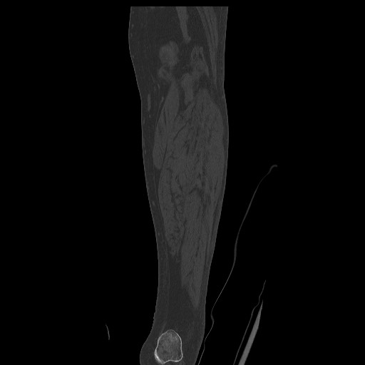 Normal CT tibia and fibula (Radiopaedia 51195-56848 Coronal non-contrast 50).jpg