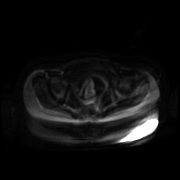 Normal MRI abdomen in pregnancy (Radiopaedia 88001-104541 Axial DWI 86).jpg