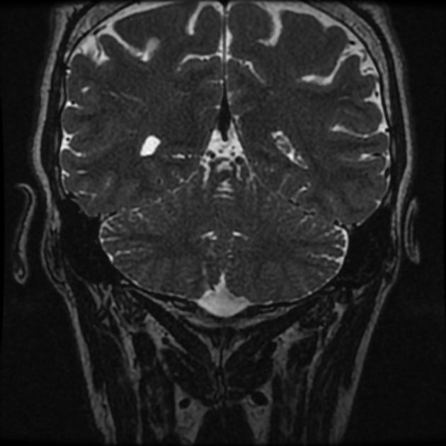 Normal MRI petrous (Radiopaedia 91317-108949 Coronal T2 104).jpg