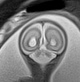 Normal brain fetal MRI - 22 weeks (Radiopaedia 50623-56050 Coronal T2 Haste 6).jpg