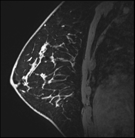 Normal breast MRI - dense breasts (Radiopaedia 80454-93850 I 124).jpg