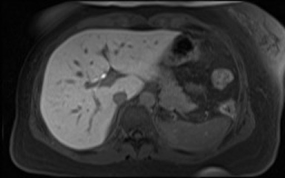 File:Normal hepatobiliary phase liver MRI (Radiopaedia 58968-66230 A 35).jpg