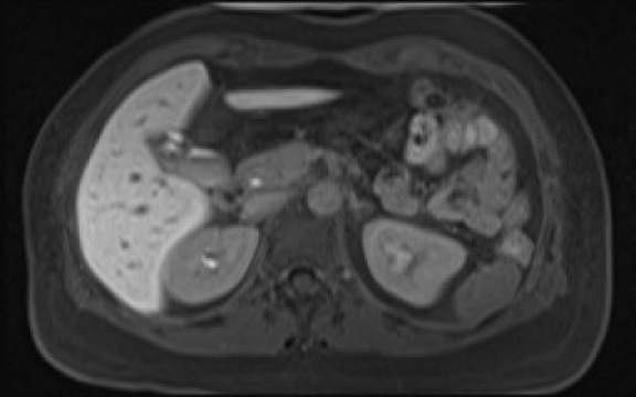 File:Normal hepatobiliary phase liver MRI (Radiopaedia 58968-66230 A 49).jpg
