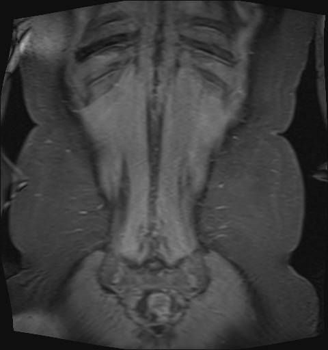 File:Normal hepatobiliary phase liver MRI (Radiopaedia 58968-66230 B 1).jpg