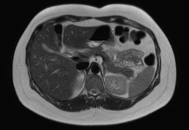 File:Normal liver MRI with Gadolinium (Radiopaedia 58913-66163 Axial T2 20).jpg