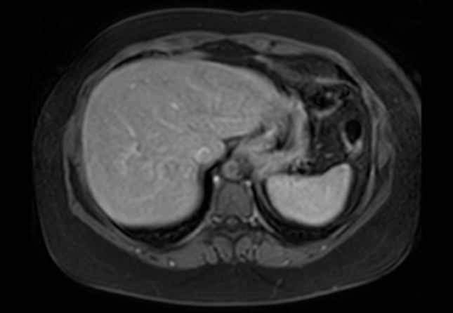 Normal liver MRI with Gadolinium (Radiopaedia 58913-66163 J 59).jpg