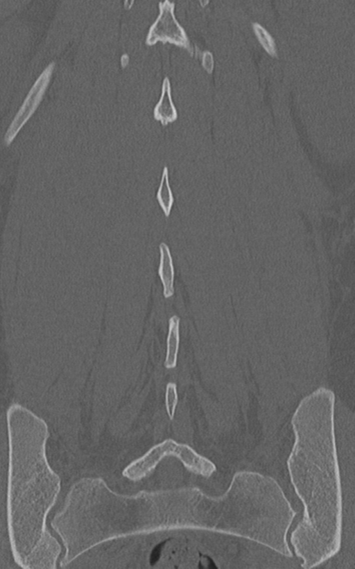 Normal lumbar spine CT (Radiopaedia 46533-50986 Coronal bone window 60).png