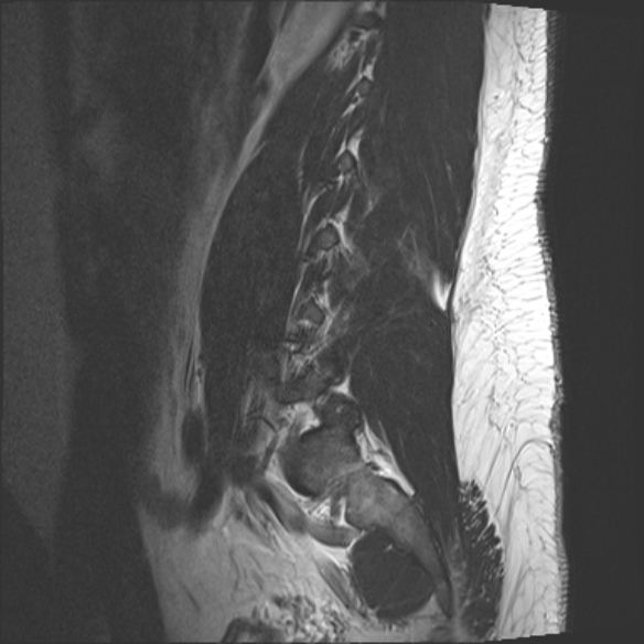 File:Normal lumbar spine MRI (Radiopaedia 47857-52609 Sagittal T2 2).jpg