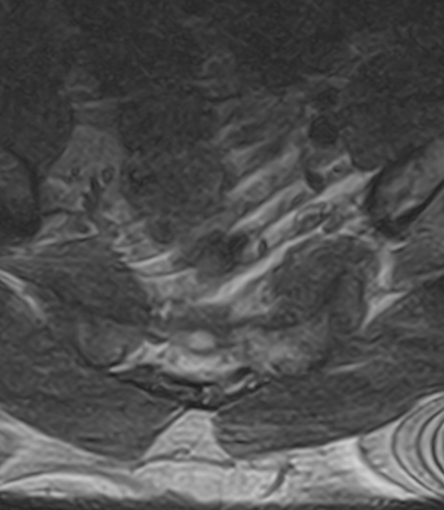 Normal lumbar spine MRI - low-field MRI scanner (Radiopaedia 40976-43699 Axial T2 103).jpg