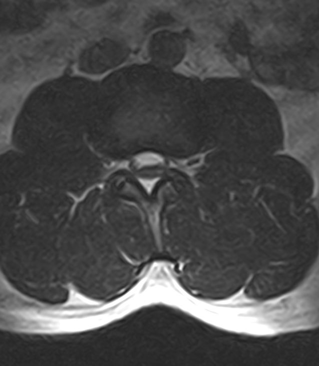 Normal lumbar spine MRI - low-field MRI scanner (Radiopaedia 40976-43699 Axial T2 47).jpg