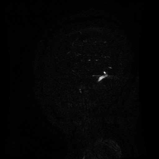 Normal noncontrast MR venography (Radiopaedia 87578-103957 A 157).jpg