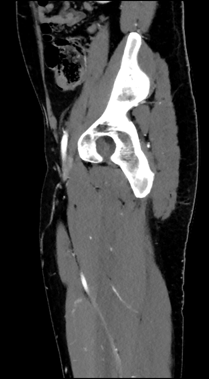 Normal pelvis CT angiogram (Radiopaedia 84966-100481 C 34).jpg