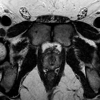 File:Normal prostate (MRI) (Radiopaedia 29986-30535 Axial T2 4).jpg