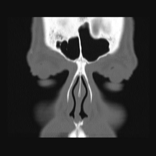 Normal sinus CT (annotated) (Radiopaedia 78917-91810 Coronal bone window 15).jpg