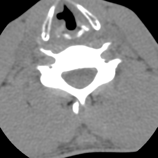 Normal trauma cervical spine (Radiopaedia 41017-43760 Axial non-contrast 40).png