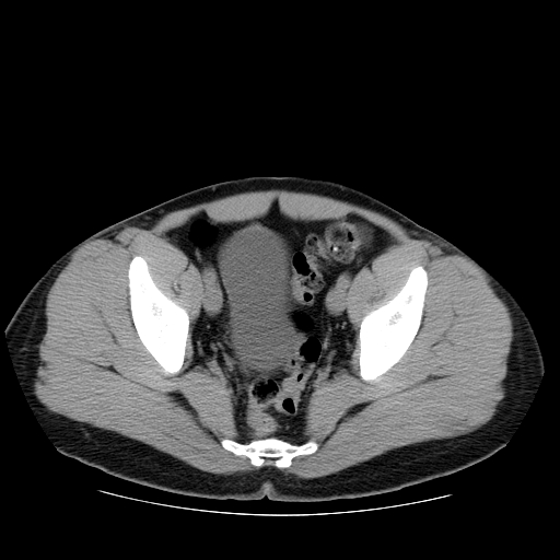 File:Obstructing ureteric calculus (Radiopaedia 18615-18514 Axial non-contrast 48).jpg