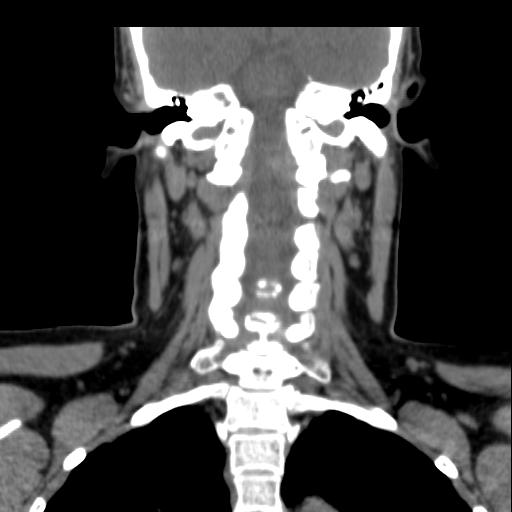 File:Obstructive sleep apnea (CT evaluation) (Radiopaedia 24304-24582 Coronal non-contrast 66).jpg
