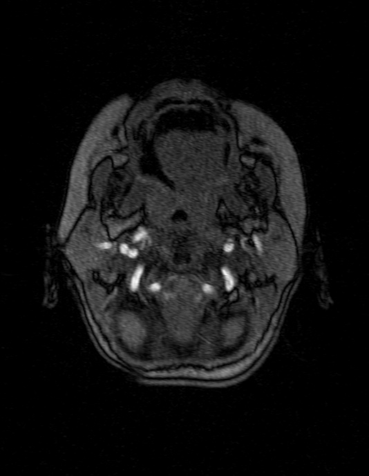 Occipital horn syndrome (Radiopaedia 14255-14129 MRA 9).jpg
