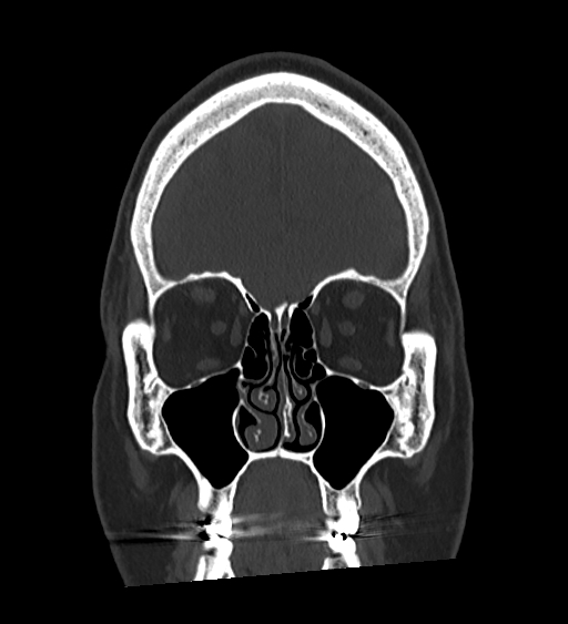 Occipital spur and Currarino type A atlas anomaly (Radiopaedia 87027-103285 Coronal bone window 44).jpg