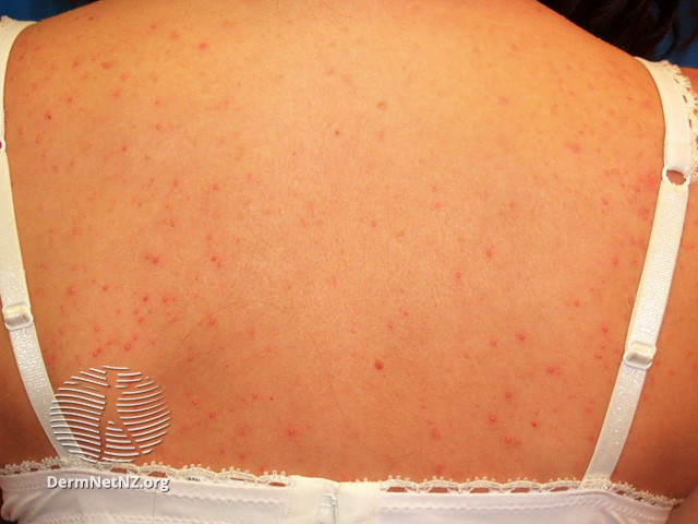 File:(DermNet NZ acne-folliculitis-2656).jpg