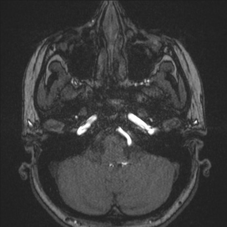 A1 segment hypoplasia (Radiopaedia 83365-97781 Axial TOF MRA 22).jpg
