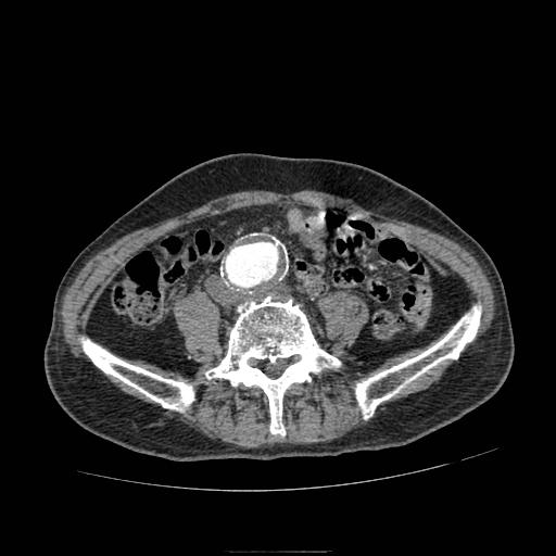 Abdominal aortic aneurysm (Radiopaedia 13341-13340 Axial C+ arterial phase 147).jpg