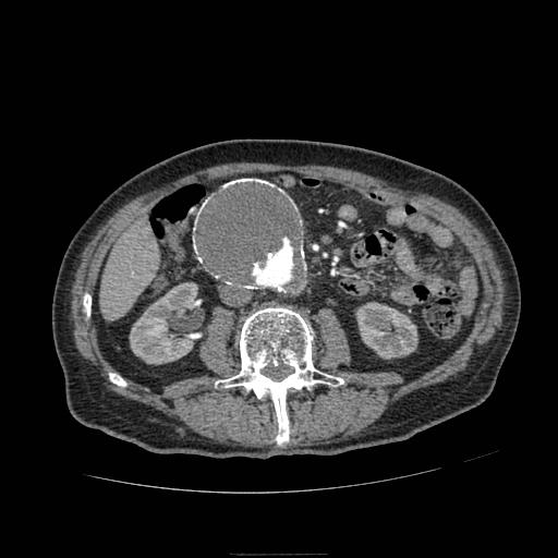 Abdominal aortic aneurysm (Radiopaedia 13341-13340 Axial C+ arterial phase 99).jpg