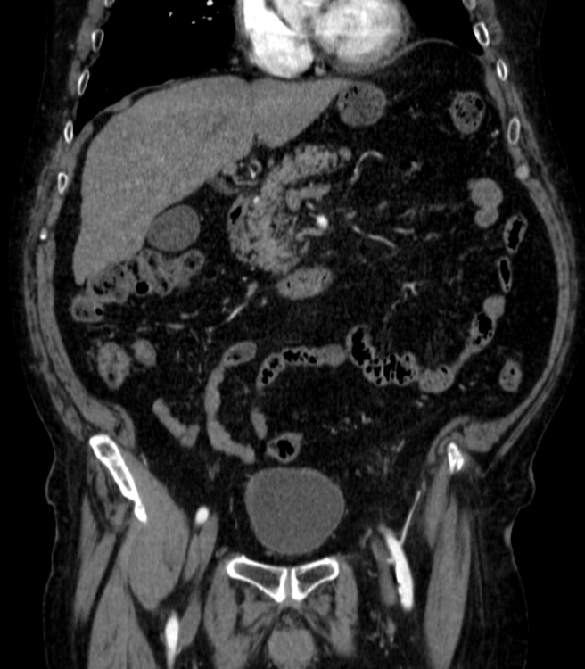 Abdominal aortic aneurysm (Radiopaedia 25855-26001 Coronal C+ arterial phase 17).jpg