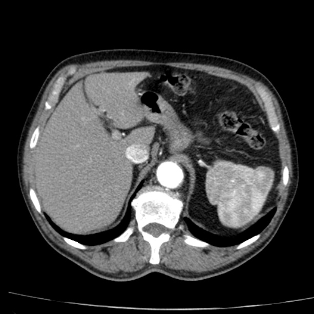 Abdominal aortic aneurysm (Radiopaedia 29248-29660 Axial C+ arterial phase 17).jpg