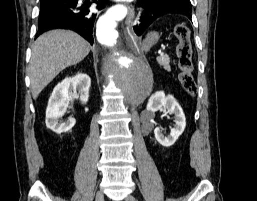 Abdominal aortic aneurysm (Radiopaedia 67117-76452 Coronal C+ arterial phase 65).jpg