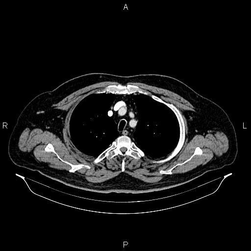 Abdominal aortic aneurysm (Radiopaedia 83094-97462 Axial renal cortical phase 18).jpg